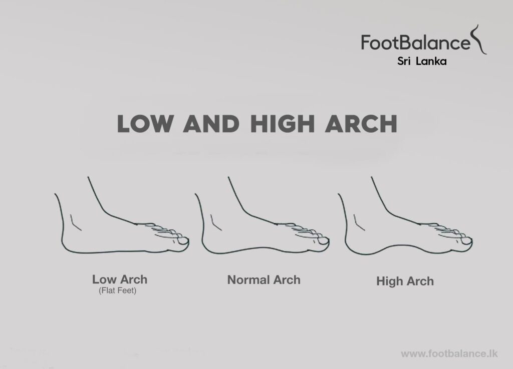 Low Arches or High Arches, Flat Feet - Solutions