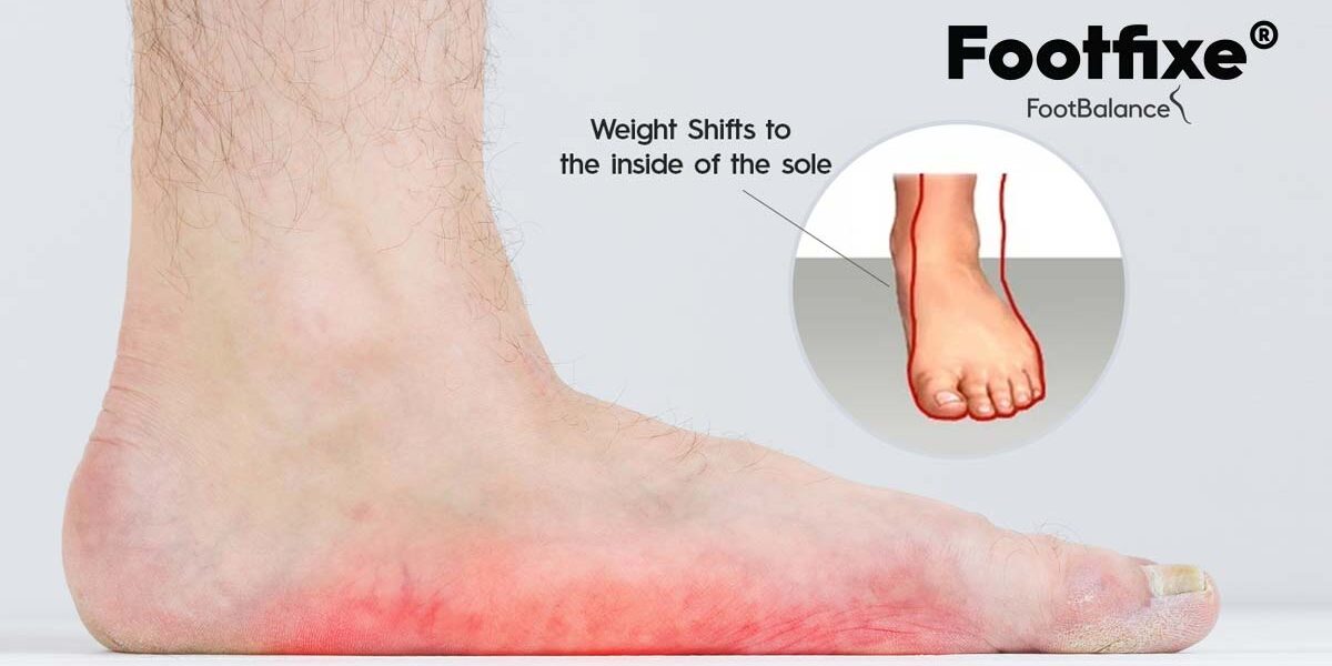 Sri-Lanka-Solution-for-Flat-Feet Flat Feet