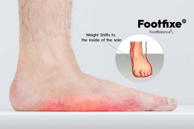 Sri-Lanka-Solution-for-Flat-Feet Flat Feet