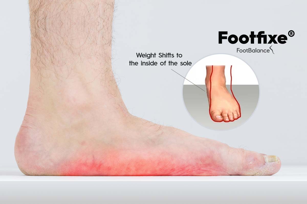 Flat Feet