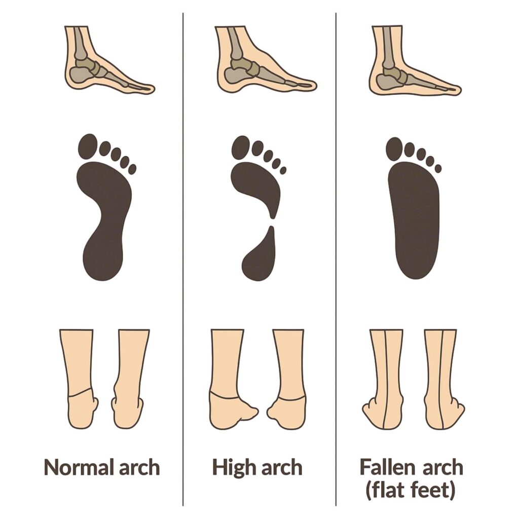 Foot Types and Arches